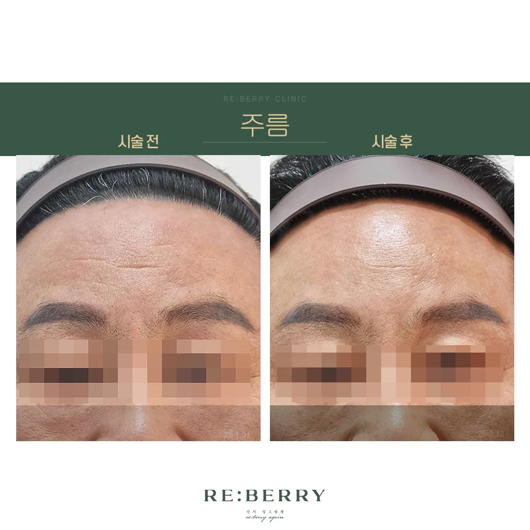 이마보톡스+이마필러 전후 — 오창점 김태균원장