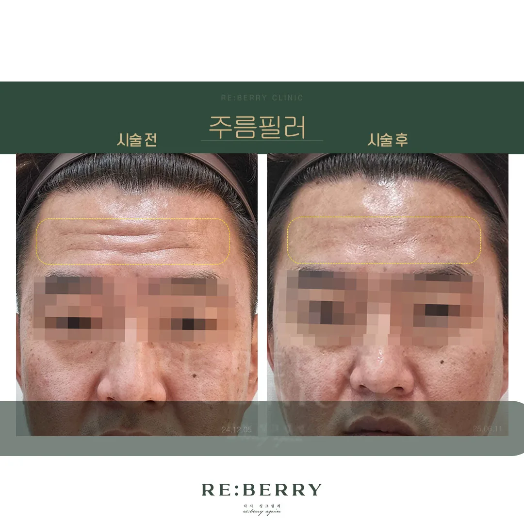 이마필러 전후 — 오창점 김태균원장