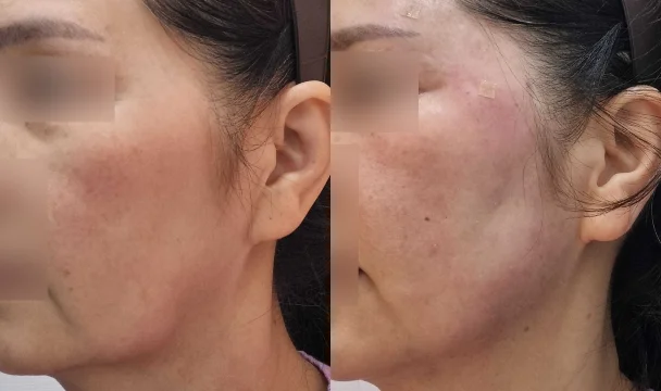 관자 필러 전후 — 청주오창점