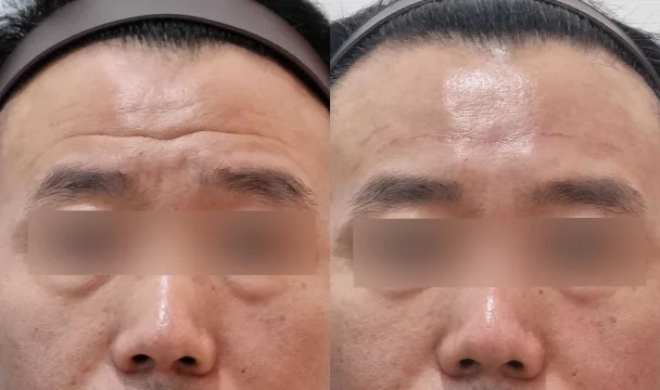 이마 주름 필러 전후 — 청주오창점