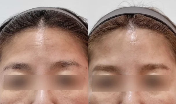 이마 주름 필러 전후 — 청주오창점