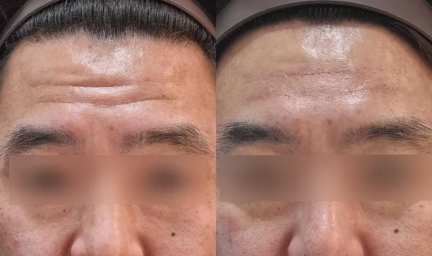 이마 주름 필러 전후 — 청주오창점