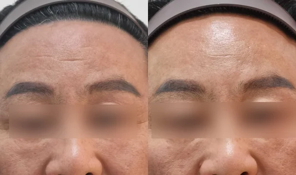 이마 주름 필러 전후 — 청주오창점
