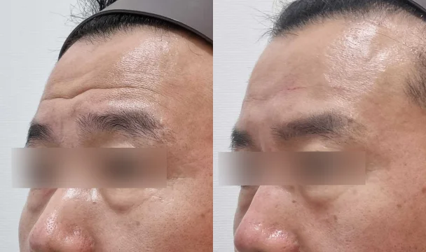이마 주름 필러(측면1) 전후 — 청주오창점
