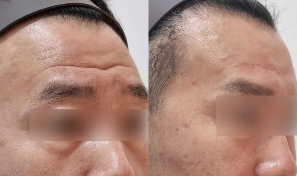이마 주름 필러(측면2) 전후 — 청주오창점