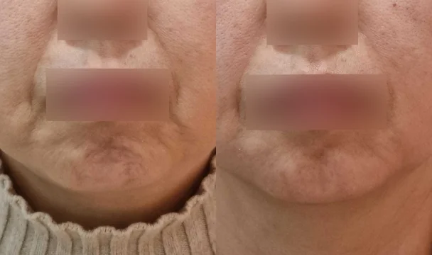 자갈턱보톡스 전후 — 청주오창점