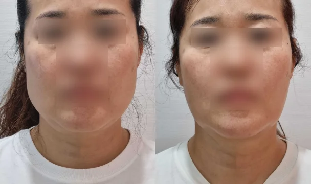 리프팅 전후 — 청주오창점