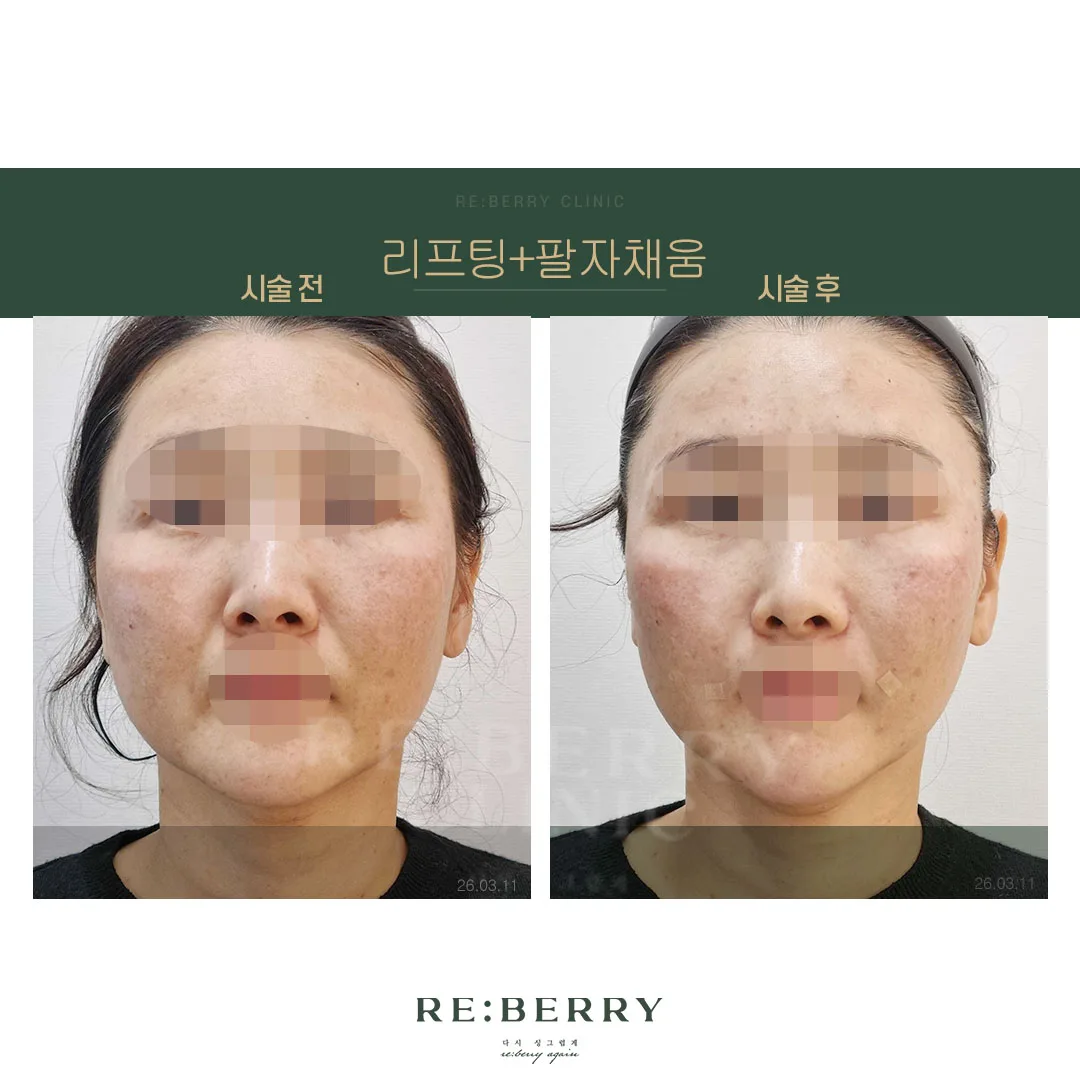 리프팅+팔자채움 전후 — 오창점 김태균원장