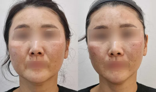 리프팅+팔자채움 전후 — 청주오창점