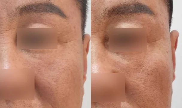 눈가 보톡스 전후 — 청주오창점