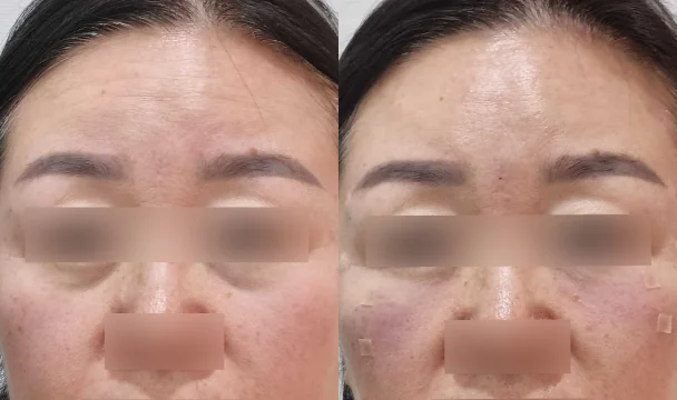 눈밑 필러 전후 — 청주오창점