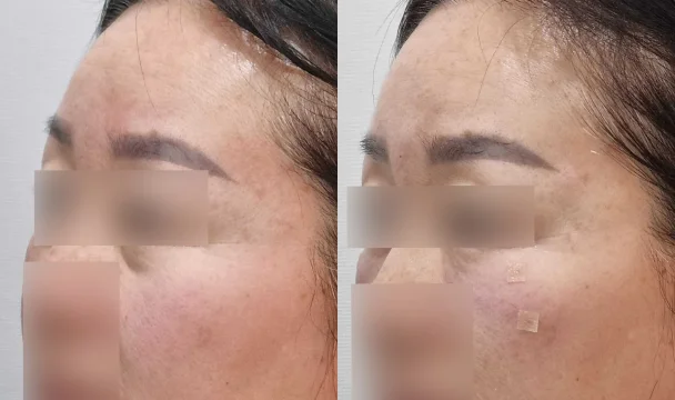 눈밑 필러(측면) 전후 — 청주오창점