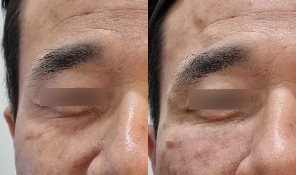 눈밑 주름 필러 전후 — 청주오창점