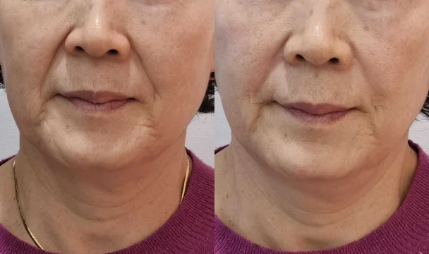 팔자 리프팅 전후 — 청주오창점