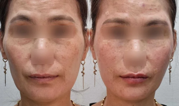 풀페이스 필러 전후 — 청주오창점