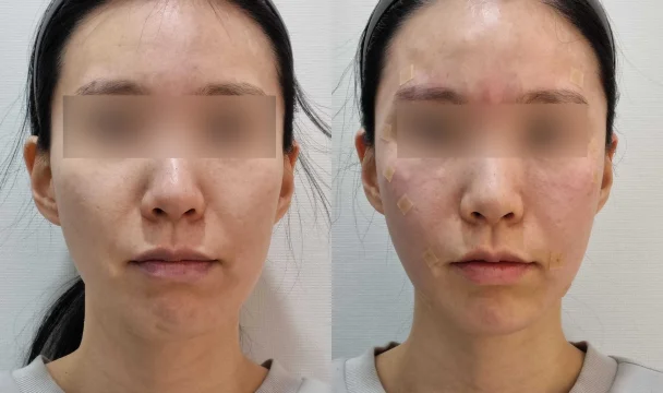 풀페이스 리볼르 전후 — 청주오창점
