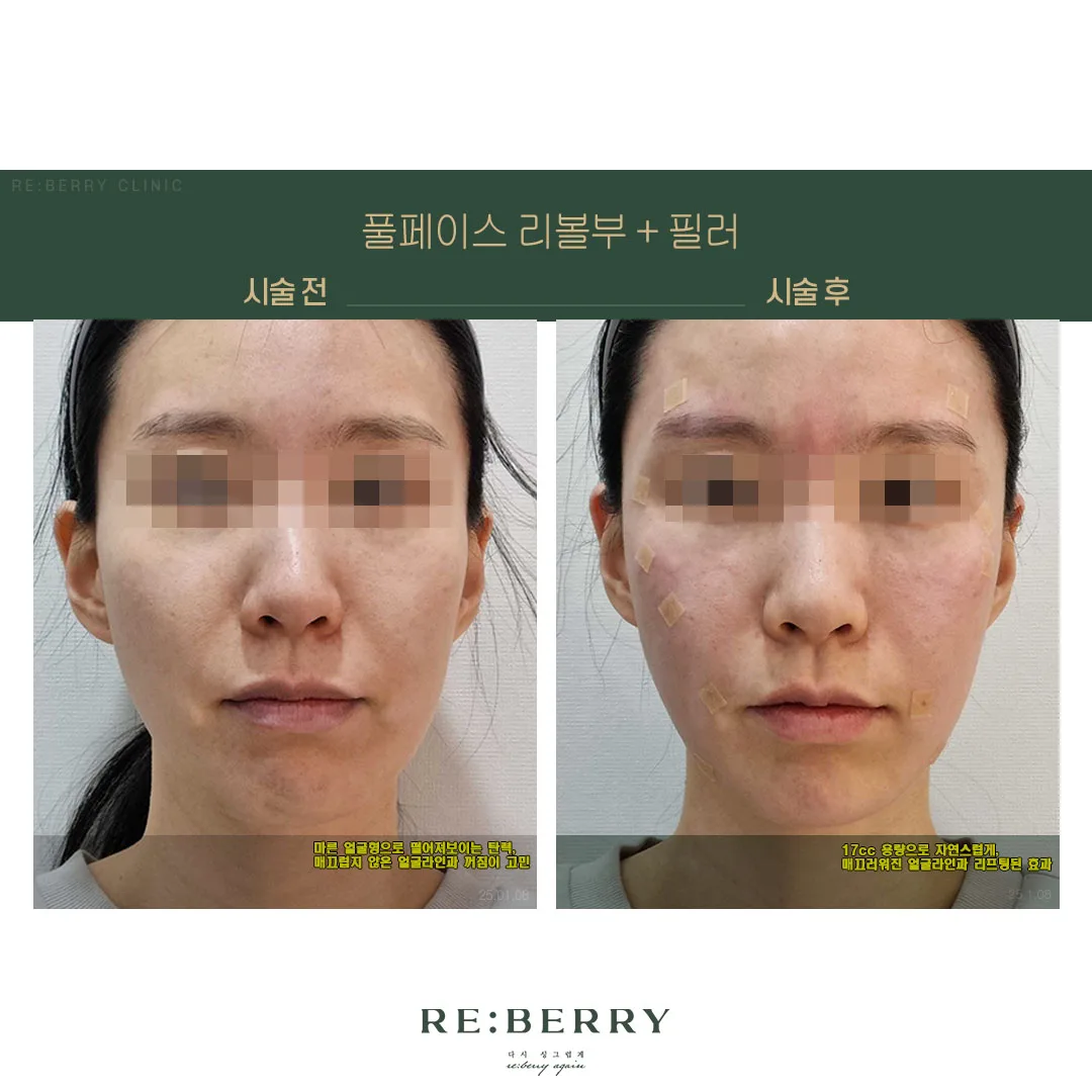 리볼르 전후 — 오창점 김태균원장