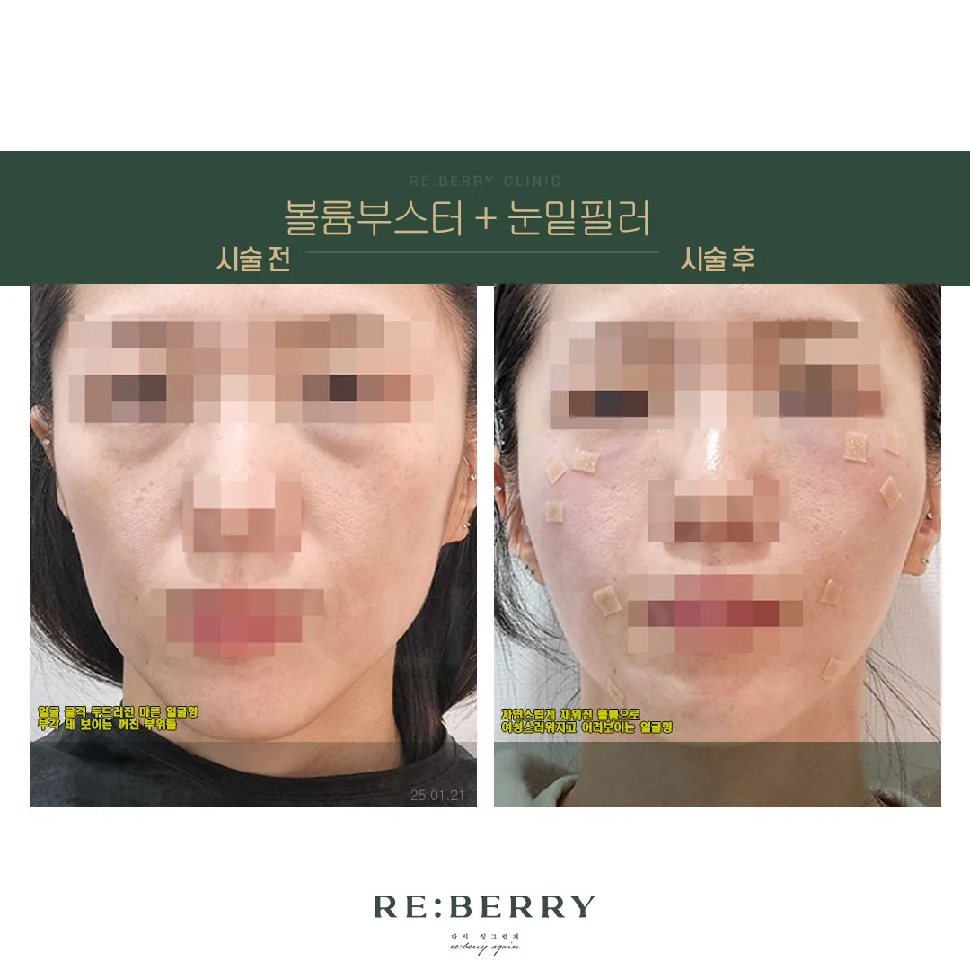 리볼르+눈밑필러 전후 — 오창점 김태균원장