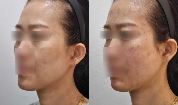 리볼르 15CC+눈밑 필러 전후 — 청주오창점