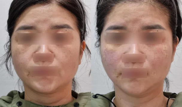리볼르+리프팅 전후 — 청주오창점