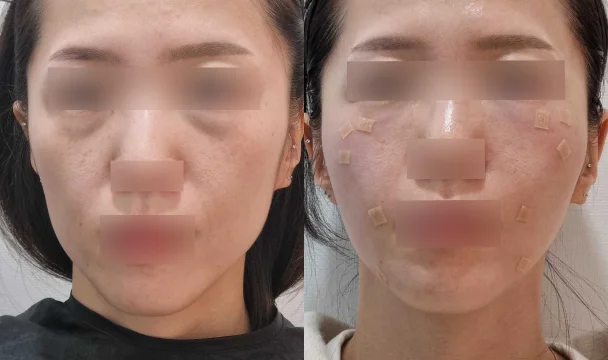리볼르+눈밑 필러 전후 — 청주오창점