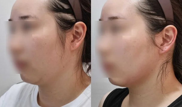 턱선 리프팅 전후 — 청주오창점