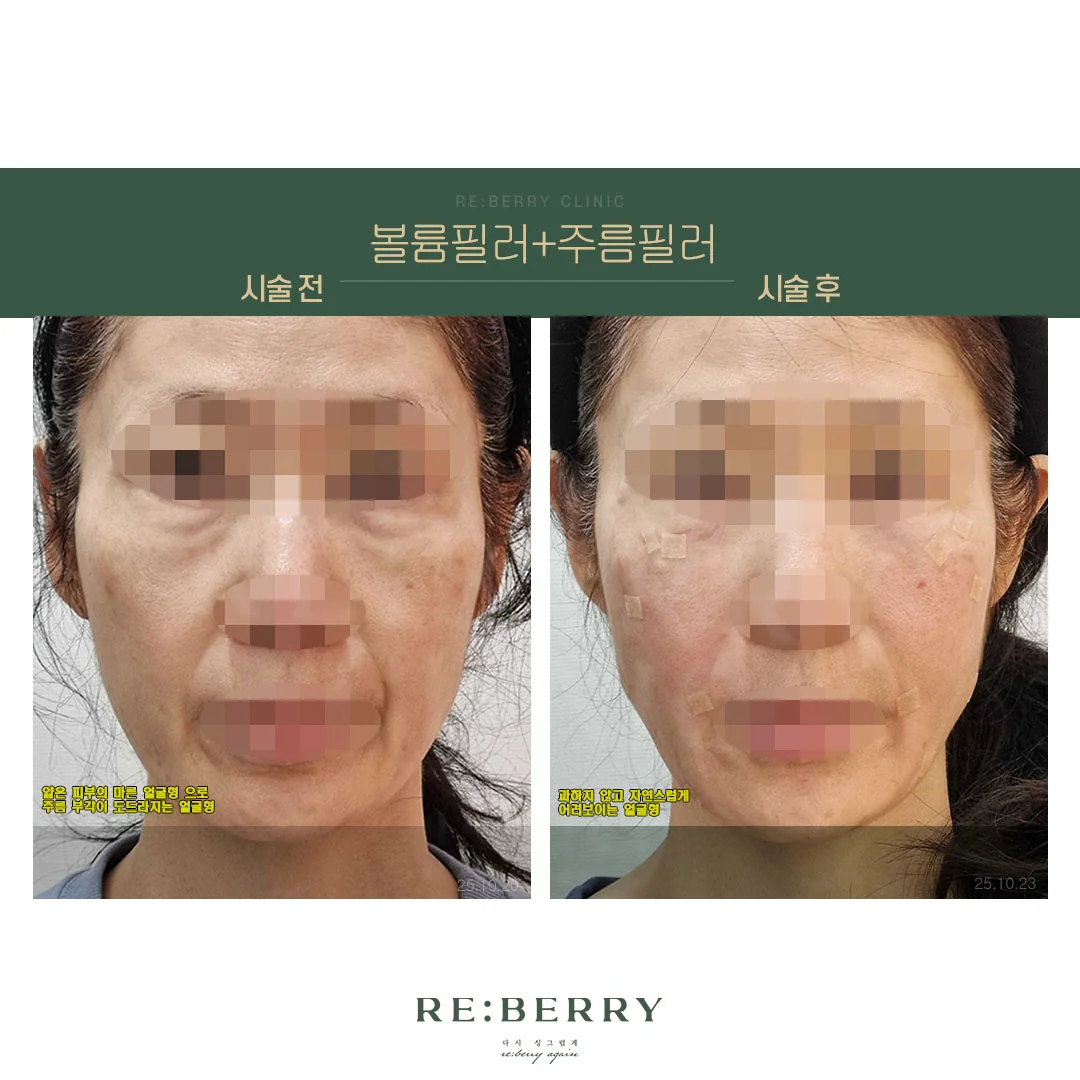 리베리의원 오창점 시술 전후 사진