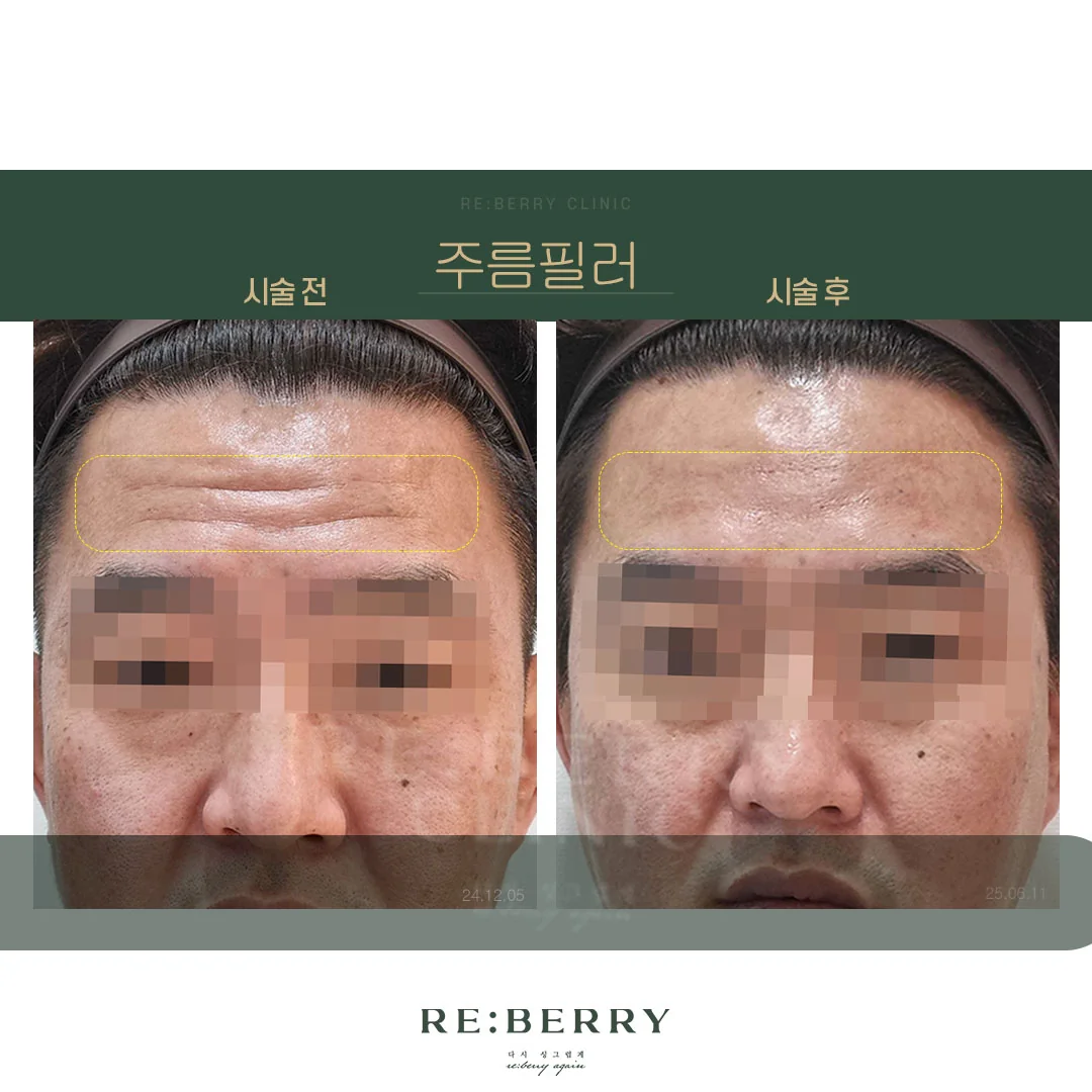 리베리의원 오창점 시술 전후 사진