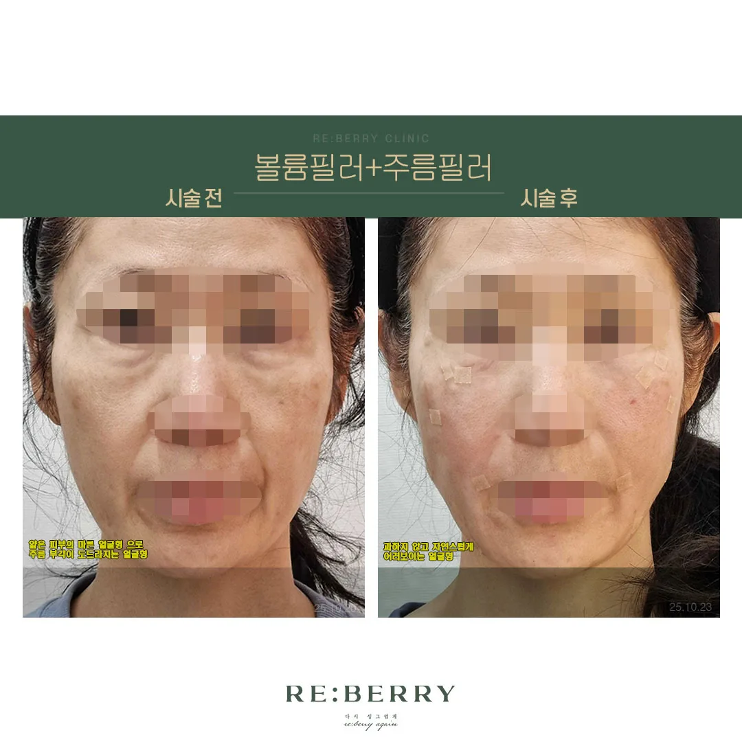볼륨+주름필러 전후 — 오창점 김태균원장