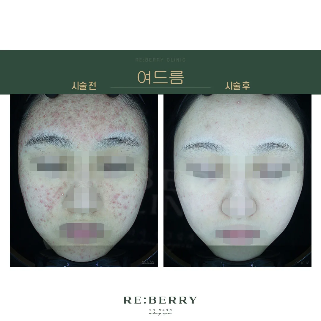 여드름 전후 — 오창점 김태균원장