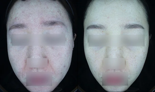 홍조 치료 전후 — 청주오창점