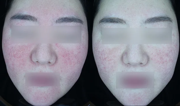홍조 치료 전후 — 청주오창점