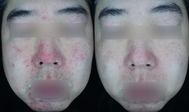 홍조 치료 전후 — 청주오창점