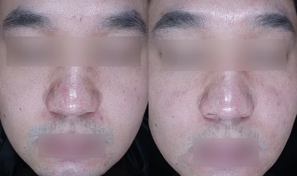 흉터 치료 전후 — 청주오창점