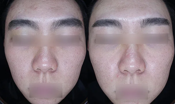 모공 치료 전후 — 청주오창점