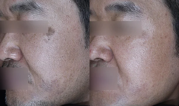 모공 치료 전후 — 청주오창점