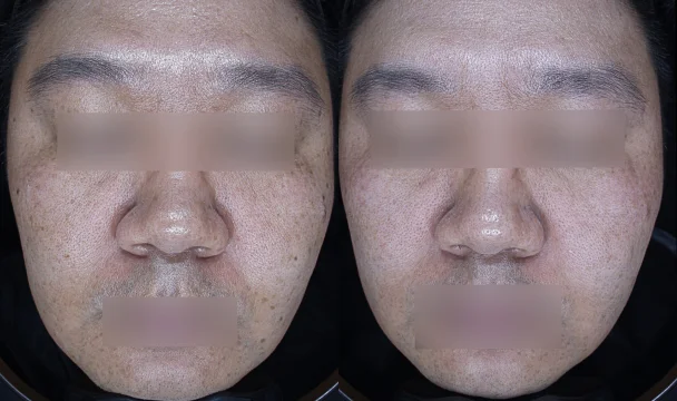 모공 치료 전후 — 청주오창점