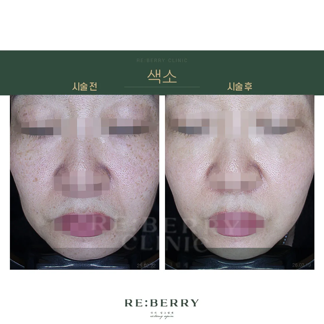 색소 전후 — 오창점 김태균원장