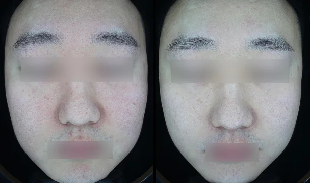 포텐자+쥬베룩 전후 — 청주오창점