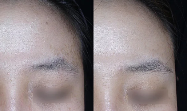 색소 치료 전후 — 청주오창점