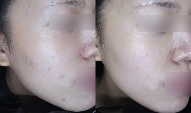 색소 치료 전후 — 청주오창점