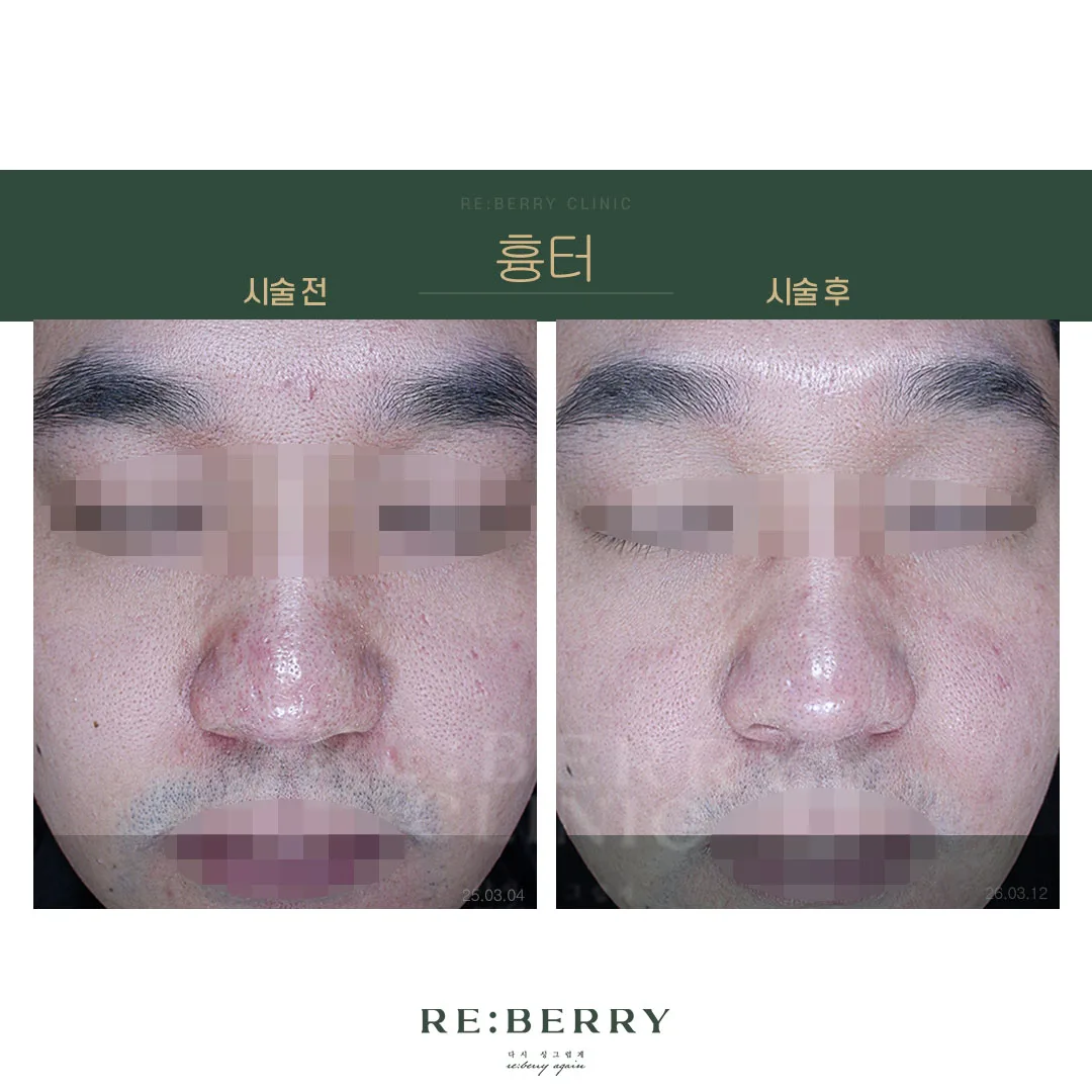 흉터 전후 — 오창점 김태균원장