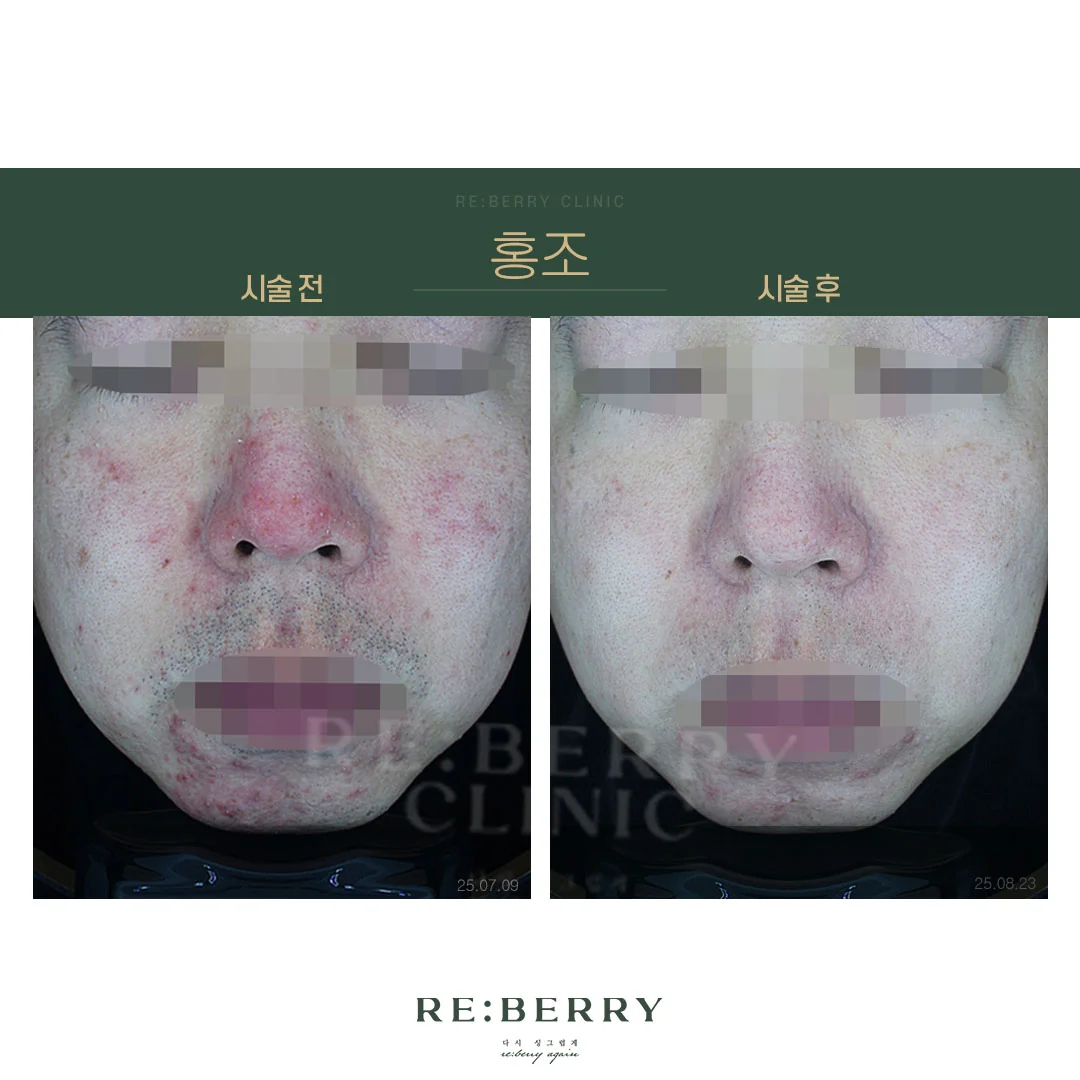 리베리의원 오창점 시술 전후 사진
