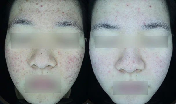 여드름 치료 전후 — 청주오창점