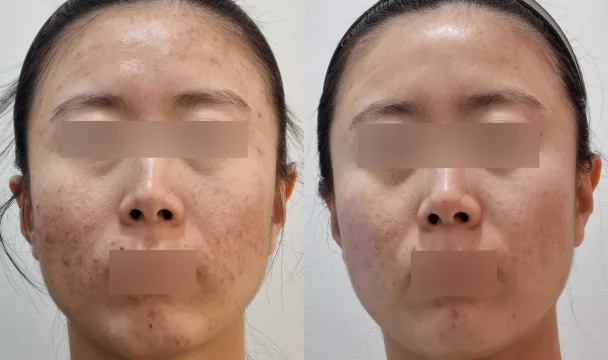 여드름 치료 전후 — 청주오창점