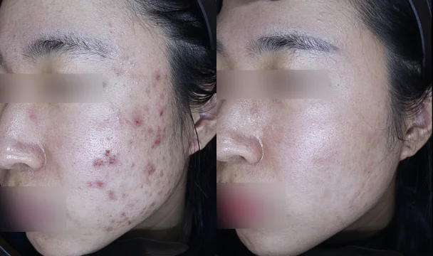 여드름 치료 전후 — 청주오창점