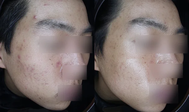 여드름 치료 전후 — 청주오창점