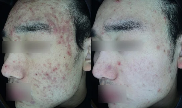 여드름 치료(측면) 전후 — 청주오창점