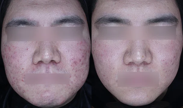 여드름 치료(정면1) 전후 — 청주오창점