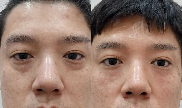 벨로테로 눈밑 필러 1cc 전후 — 동탄점